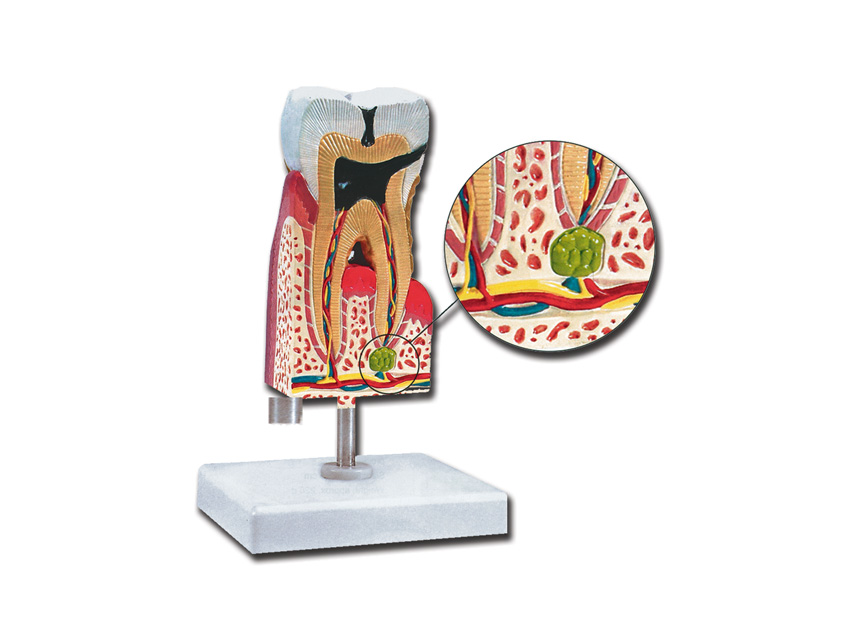 Lower MOLAR WITH CARIES - 10X