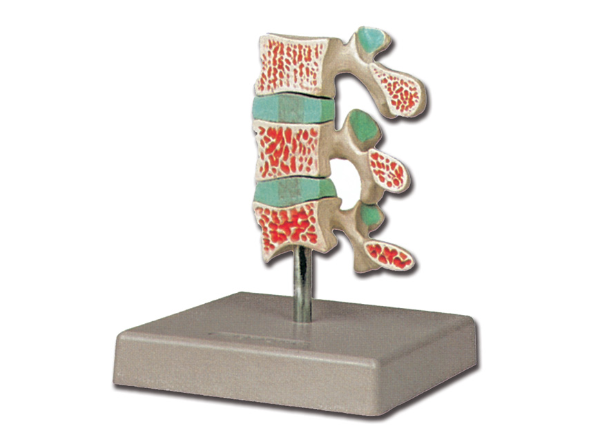 Modeļi -cilvēka anatomija, Osteoporozes modelis