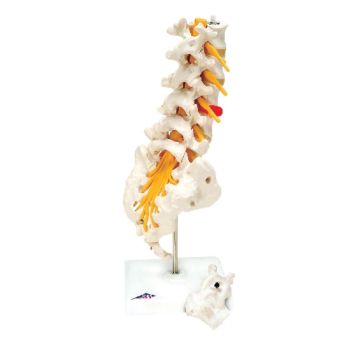 003Lumbar Spinal Column with Dorso-Lateral Prolapsed Intervertebral Disc