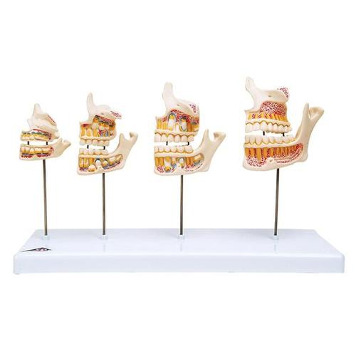 Dental model, Dentition Development
