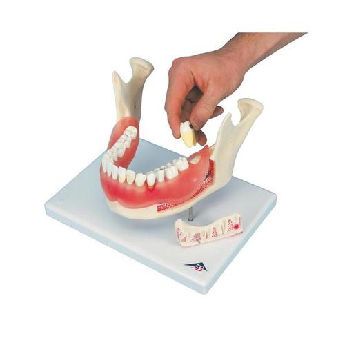 Dental model, Dental disease, magnified 2 times, 21 parts