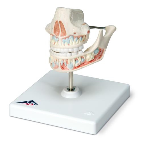 Dental model, Milk Dentures