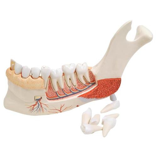 Dental model, Advanced Half Lower Jaw with 8 diseased teeth, 19 part