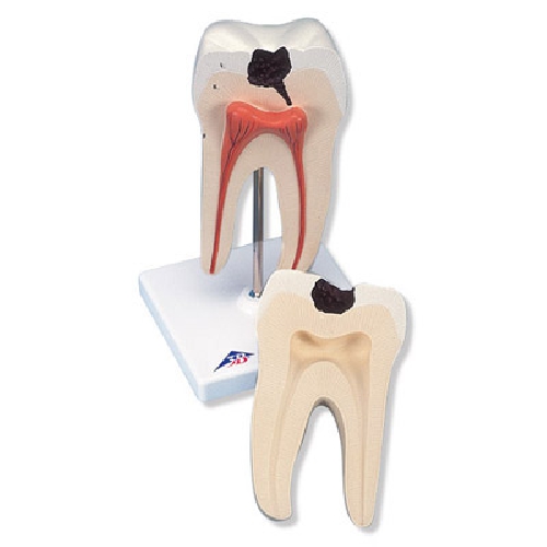 Dental model, Lower Twin-Root Molar showing cavities, 2 part