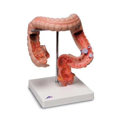 DIGESTIVE SYSTEM MODELS, Intestinal diseases