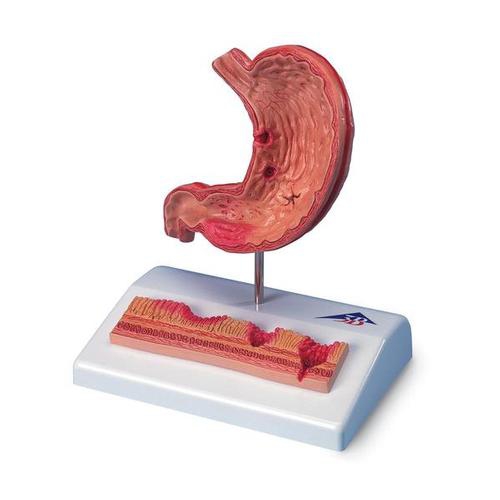 DIGESTIVE SYSTEM MODELS, Stomach with Ulcers
