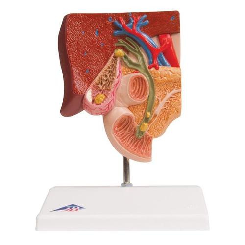 DIGESTIVE SYSTEM MODELS, Gallstone Model