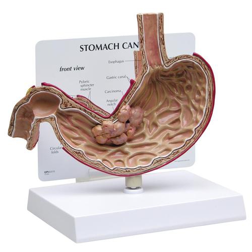 DIGESTIVE SYSTEM MODELS, Stomach Cancer Model