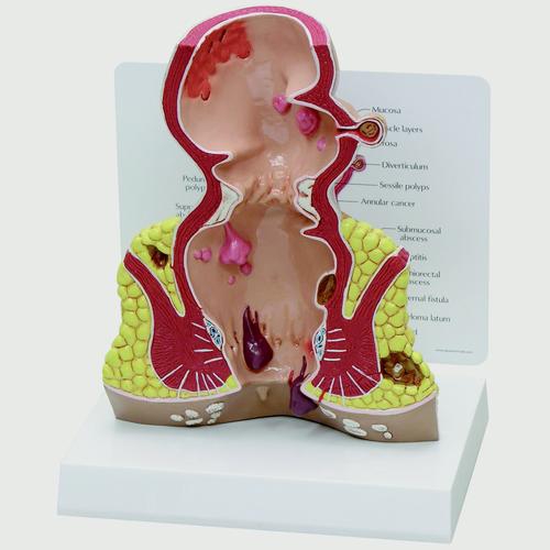 DIGESTIVE SYSTEM MODELS, Rectum cross section (oversize) with pathologies