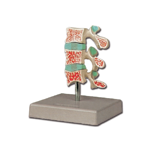 OSTEOPOROZES MODELIS